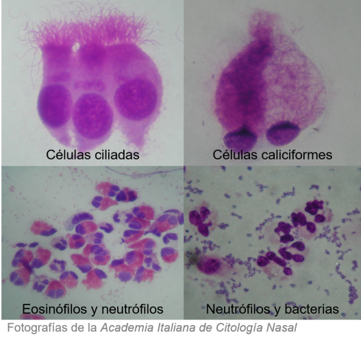 citologia-nasal-citotipos citologia-nasal-citotipos